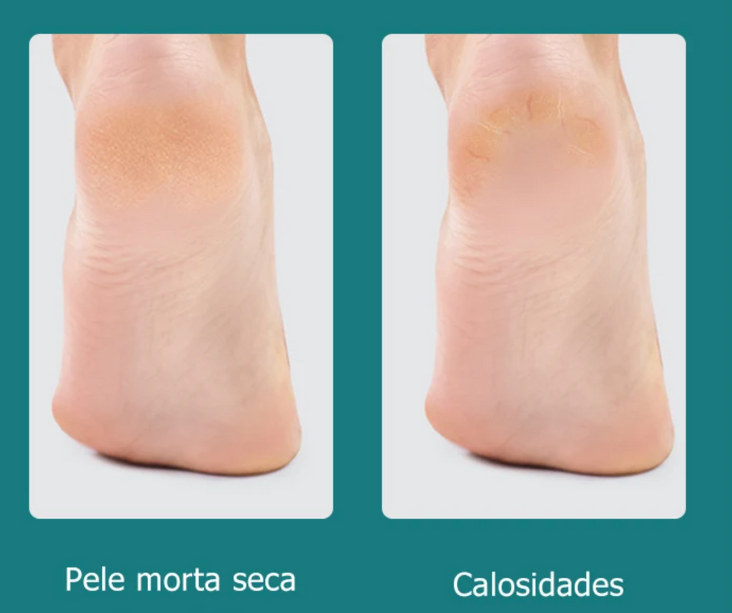 Removedor de Calos e Rachaduras Dupla Face